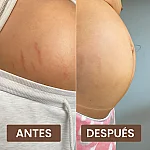 ELIMINA 95% DE ESTRIAS ACEITE DE PATA DE VACA MASERADO 100% NATURAL imagen 1